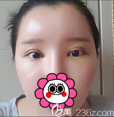 在韩国DI整形医院做全脸脂肪填充+全切双眼皮手术后7天