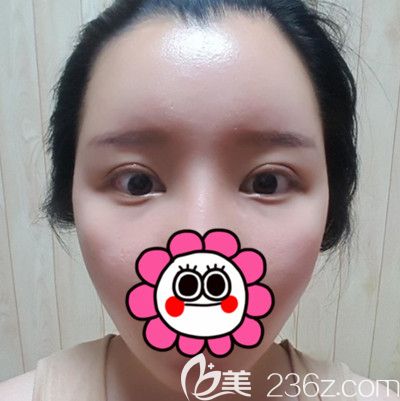 在韩国DI整形医院做全脸脂肪填充+全切双眼皮手术后2周