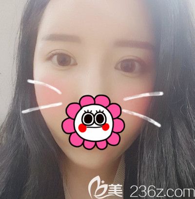 在韩国DI整形医院做全脸脂肪填充+全切双眼皮手术后1个月