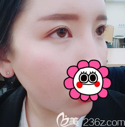 分享选择韩国DI整形医院做全脸脂肪填充+全切双眼皮手术2个月的恢复过程