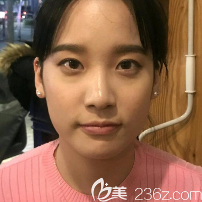 在广州紫馨做眼睛修复术前照片 在广州紫馨做眼睛修复术前照片