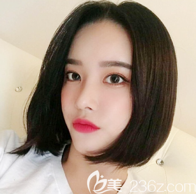 找广州紫馨曹仁昌做的眼睛修复两个月自拍 找广州紫馨曹仁昌做的眼睛修复两个月自拍