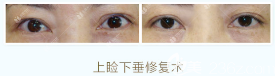 找曹仁昌做的眼睛修复案例对比图 找曹仁昌做的眼睛修复案例对比图