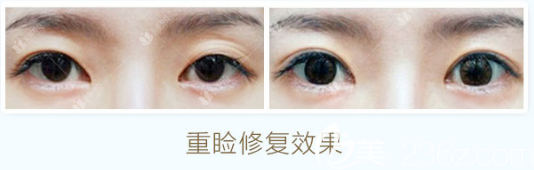 曹仁昌做的初眼重睑修复案例 曹仁昌做的初眼重睑修复案例