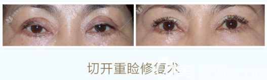曹仁昌切开双眼皮修复案例 曹仁昌切开双眼皮修复案例