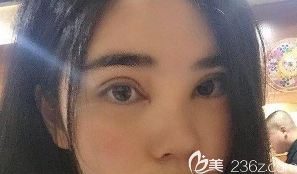 切开双眼皮第7天双眼的弧度已经有了形状