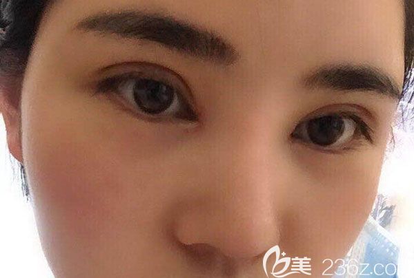 眼综合第20天肿胀已经消退