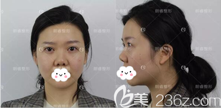 隆鼻手术前正面侧面照片 隆鼻手术前正面侧面照片