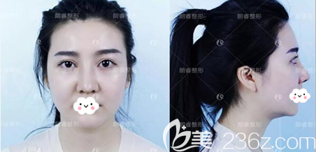 肋软骨鼻综合手术后正面侧面照片 肋软骨鼻综合手术后正面侧面照片