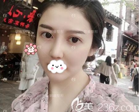 年后找卢刚做了肋软骨鼻综合手术改善短鼻，我成功摘掉猪猪鼻女孩称号