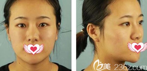 在昆明梦想整形隆鼻手术前 在昆明梦想整形隆鼻手术前