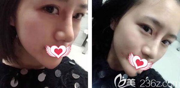 耳软骨垫鼻尖第7天形态已经自然了 耳软骨垫鼻尖第7天形态已经自然了