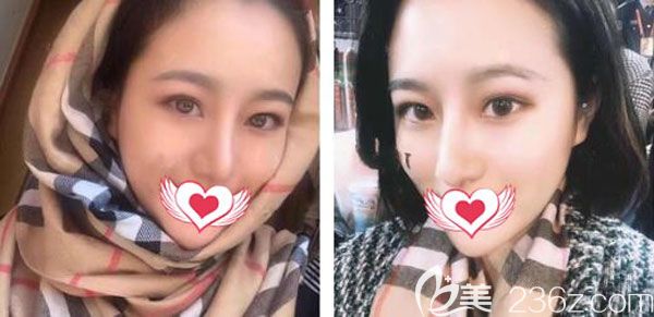 耳软骨复合隆鼻一个月基本已经定型 耳软骨复合隆鼻一个月基本已经定型