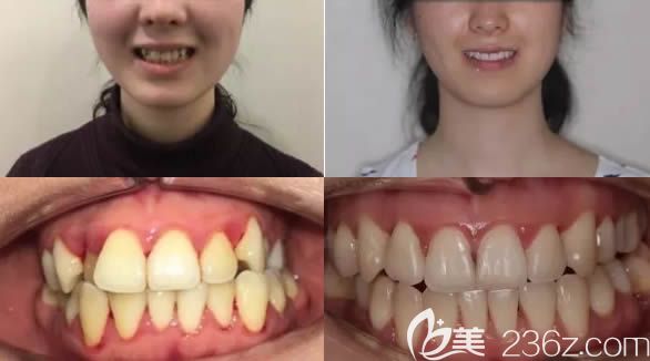 北京牙管家口腔牙齿正畸效果对比图