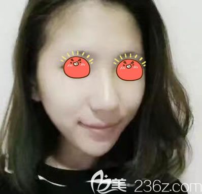 绍兴上虞艺美自体脂肪填充<span style=