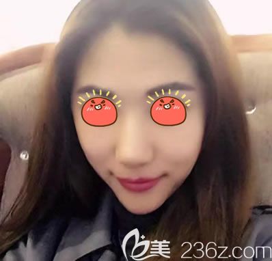 绍兴艺美自体脂肪填充<span style=