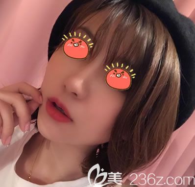 绍兴上虞一美整形的名气挺大的,看院长给我做的大腿吸脂和自体脂肪全脸填充效果怎么样