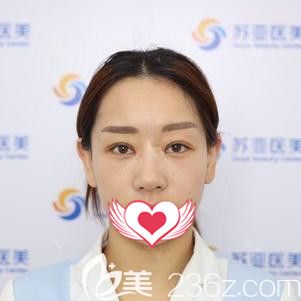 在唐山美联臣做眼综合术后7天双眼皮拆线