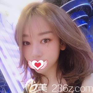 李春雷医生为我做眼综合术后18天消肿