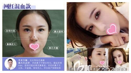 蒋松林院长打造网红混血鼻真人前后效果对比图