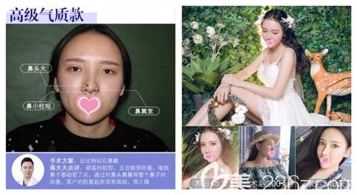 蒋松林院长打造气质上镜鼻真人前后效果对比照片