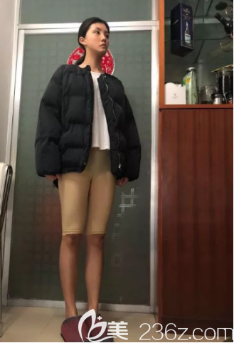 吸脂一个月的样子