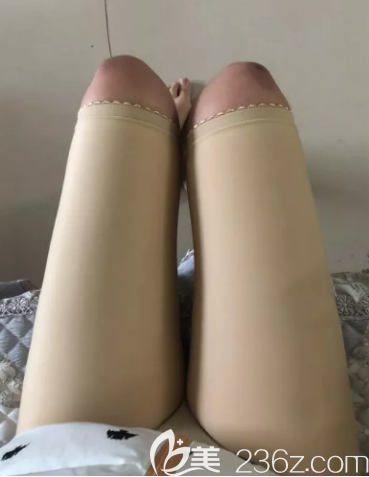 吸脂两个月的样子