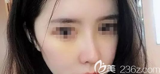 包头叶子张会堂鼻综合隆鼻第七天拆线后照片