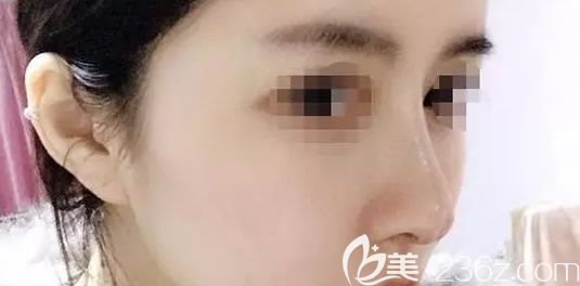 假体隆鼻半个月效果