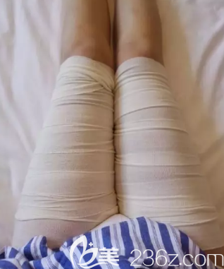 吸脂瘦大腿手术刚做完的时候
