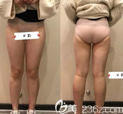吸脂术前照片 吸脂术前照片
