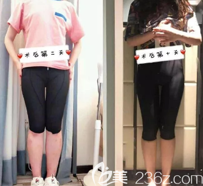 吸脂第十天的照片 吸脂第十天的照片