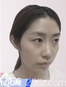 韩国然美之做全脸脂肪填充+鼻子微整形术前 韩国然美之做全脸脂肪填充+鼻子微整形术前