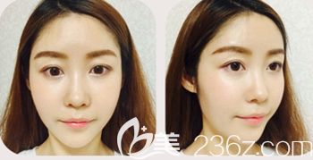 韩国然美之做全脸脂肪填充+鼻子微整形术后7天 韩国然美之做全脸脂肪填充+鼻子微整形术后7天