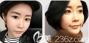 韩国然美之做全脸脂肪填充+鼻子微整形术后15天 韩国然美之做全脸脂肪填充+鼻子微整形术后15天