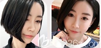 韩国然美之做全脸脂肪填充+鼻子微整形术后1个月