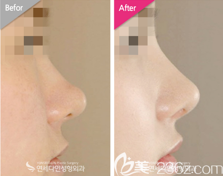 韩国延世多仁整形医院金均泰鼻综合隆鼻<span style=