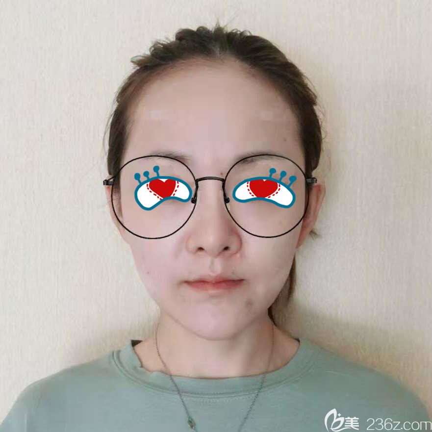 杨鹏做做完自体脂肪填充第7天