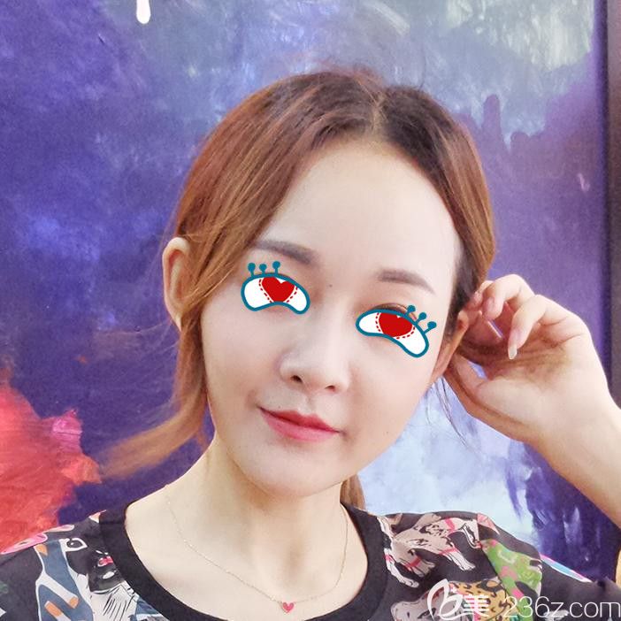 在合肥华美做全脸填充自体脂肪一个月