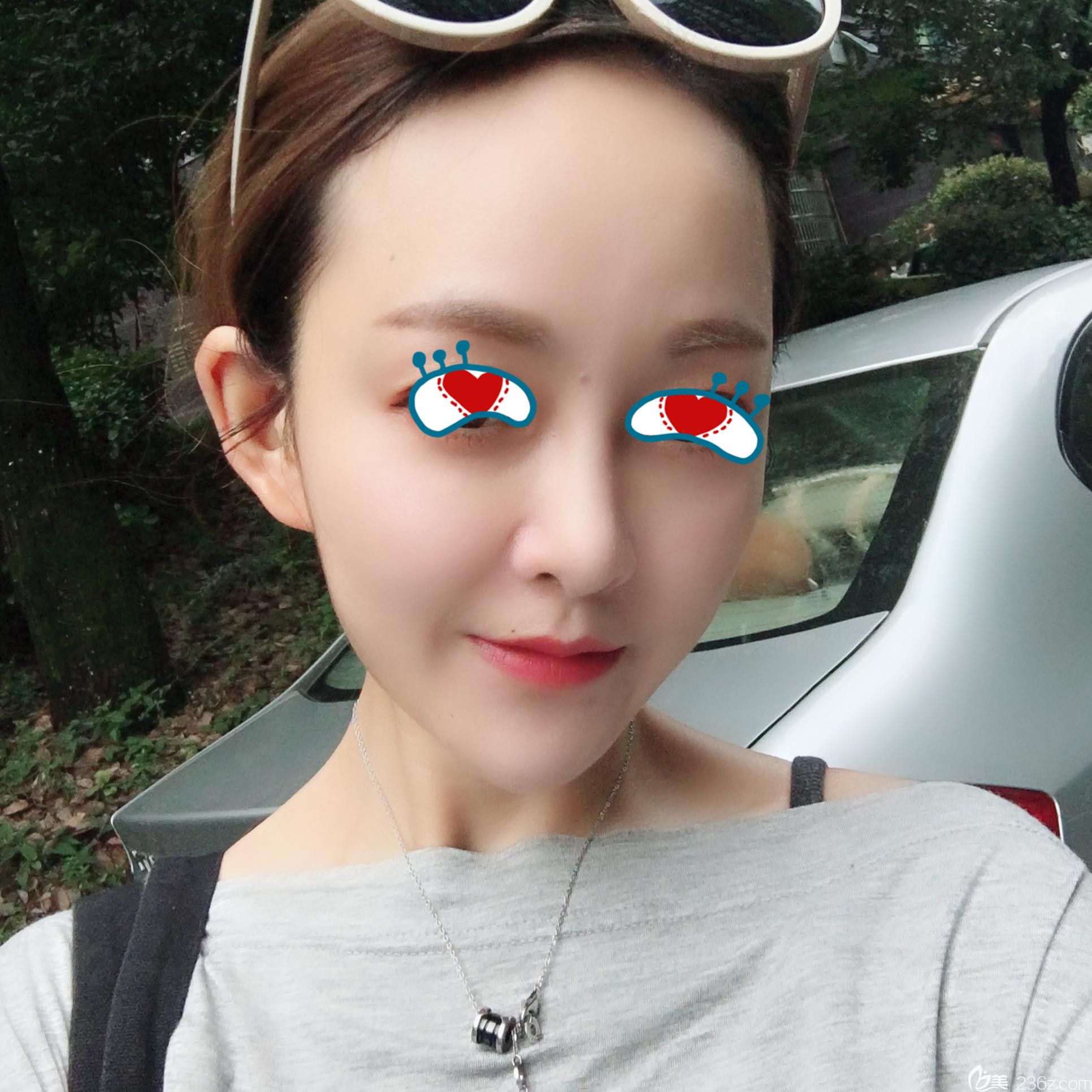 华美整形自体脂肪填充2个月恢复情况