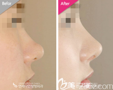 韩国延世多仁金均泰院长隆鼻案例