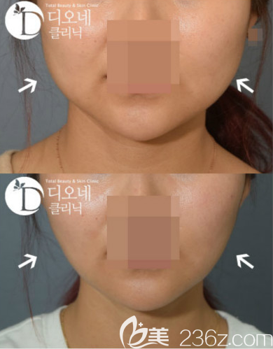 韩国DIONE吸脂皮肤门诊注射瘦脸除皱瘦脸针案例