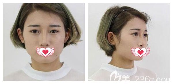 在昆明梦想割双眼皮手术前 在昆明梦想割双眼皮手术前