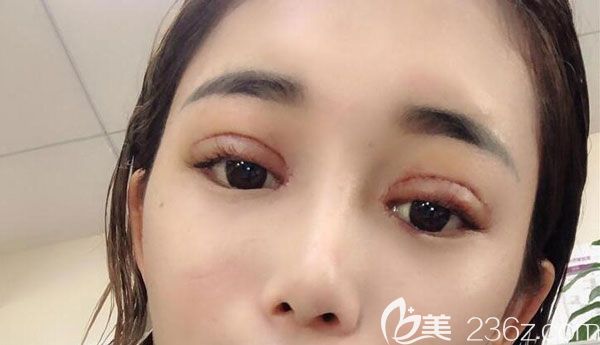 眼综合手术第7天线条自然 眼综合手术第7天线条自然