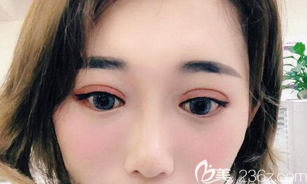 眼综合术后30天疤痕也不明显 眼综合术后30天疤痕也不明显