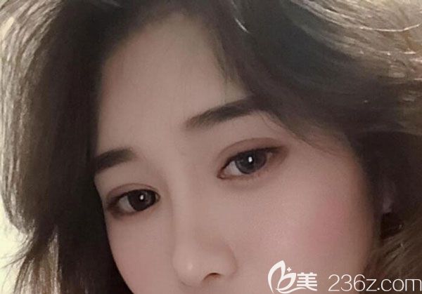 割双眼皮两个月没有发现水肿 割双眼皮两个月没有发现水肿