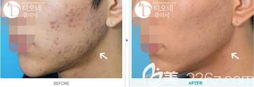 韩国DIONE吸脂皮肤门诊林珠延毛孔粗大修复案例