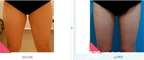 韩国DIONE吸脂皮肤门诊大腿抽脂案例