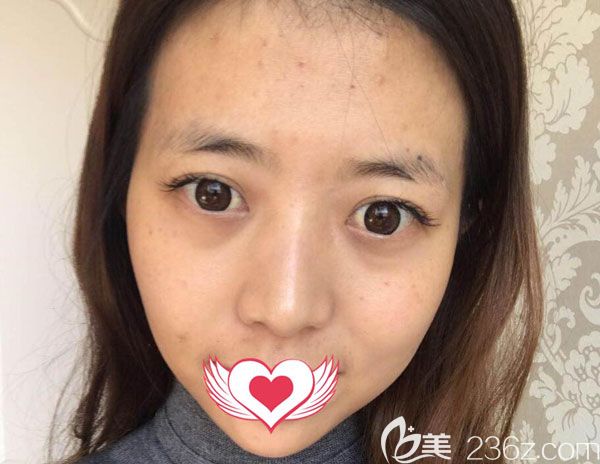 在<!--<i data=20240703-sp></i>-->整形做自体脂肪面部填充手术前 在<!--<i data=20240703-sp></i>-->整形做自体脂肪面部填充手术前