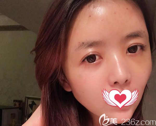 全脸填充第7天肿胀基本已经消退 全脸填充第7天肿胀基本已经消退